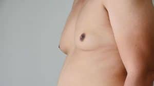 gynecomastie homme gynecomastie paris docteur hocine bouabid chirurgien esthetique paris 5 chirurgien plasticien paris 5