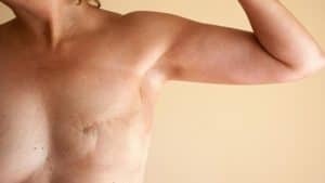 reconstruction mammaire apres cancer du sein docteur hocine bouabid chirurgien esthetique paris 5 chirurgien plasticien paris 5